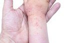 A dermatomiosite juvenil é uma doença crônica, autoimune, que pode afetar vários órgãos e sistemas do corpo, caracterizada por inflamação crônica da pele e dos músculos. 